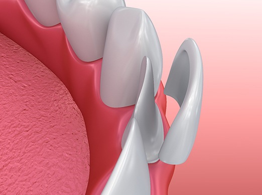 Illustration of veneer being placed on bottom tooth